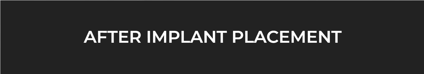 AFter implant Placement