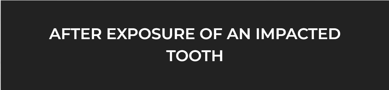 After Exposure Of AN Impacted Tooth